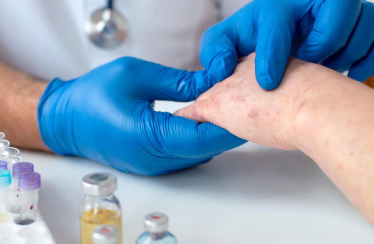 First case of highly transmissible mpox strain hits UK